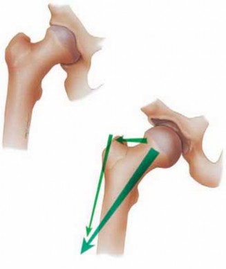 Illustration 14 for Solving Hip Soft Tissue Pathology with Advanced Arthroscopy