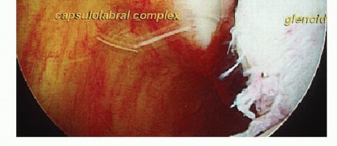 Illustration 4 for Regain Stability: Arthroscopy for Anterior Instability & the Inferior Glenohumeral Ligament