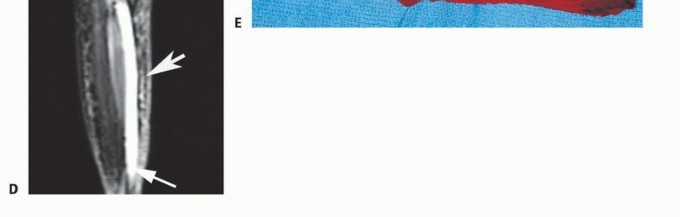 Illustration 15 for Soleus Resection for Tumors: Protecting the Heads of the Gastrocnemius