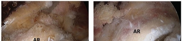 Illustration 24 for Beyond Knee Surg: Hip Arthroscopy for Sports Injuries