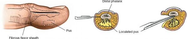 Illustration of pulp space infection - Dr. Mohammed Hutaif