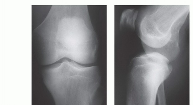 Illustration 6 for Tackling Complex Tumors of the Proximal Tibia: Limb-Sparing Solutions
