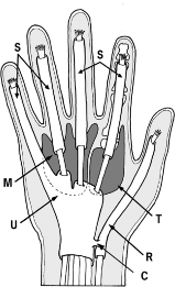 Dupuytren's: Preventing Damage to Your Distal Interphalangeal Joint