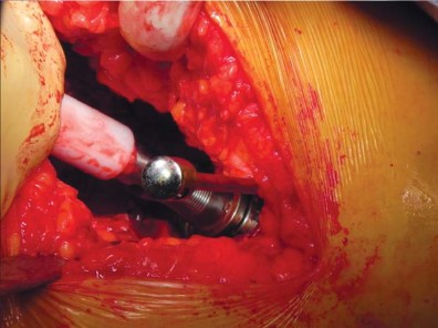 Illustration 16 for Unlock better THA: The technique of short stem for less invasiveness