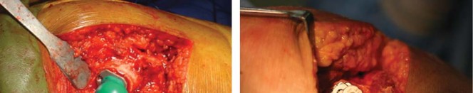 Illustration 20 for Considering METHA Short Stem? Discover Bone-Preserving THA