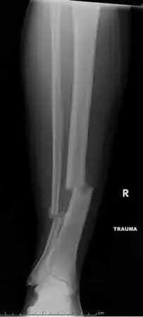 OrthoCash: Trauma MCQs & Cases for a yearold woman