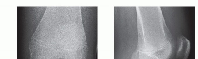 Illustration 7 for Treating Tibial Spine Fractures: Arthroscopy or Open Reduction?