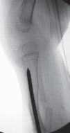 Illustration 19 for Solving Congenital Pseudarthrosis: Tibia with the Williams Rod