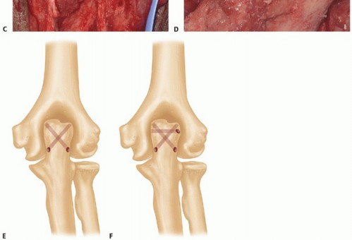 Illustration 40 for Distal Humeral Fractures: When Is Elbow Replacement the Best Option?