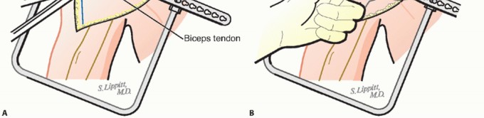 Illustration 14 for Hemiarthroplasty for Proximal: Effective Treatment for Fractures