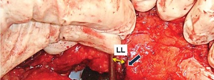 صورة طبية: إتقان توازن الأنسجة الرخوة لمفصل ورك صناعي مثالي: دليل شامل للمرضى مع الأستاذ الدكتور محمد هطيف