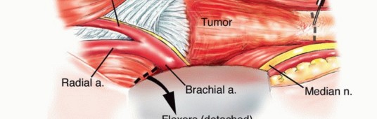 Illustration 12 for Distal Humeral Resection: Safe Techniques for Limb Preservation