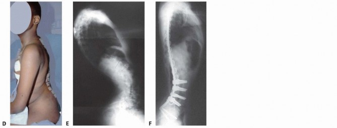 Illustration 36 for Duchenne Muscular Dystrophy: Is Spinal Fusion the Answer?