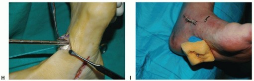 Illustration 39 for Restore Movement: Tendon Transfer for Common Peroneal Nerve Foot Drop
