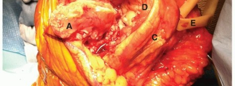 Illustration 45 for Surgical Approaches to Shoulder & Elbow: Pearls and Pitfalls