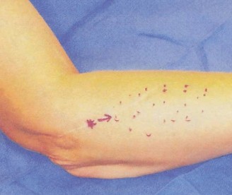 Illustration 19 for Solve Orthopedic Cases: Extensor Carpi Radialis Brevis & Elbow Pain