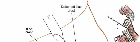 Illustration 19 for Mastering the Posterior Iliac Crest for Bone Graft Harvest