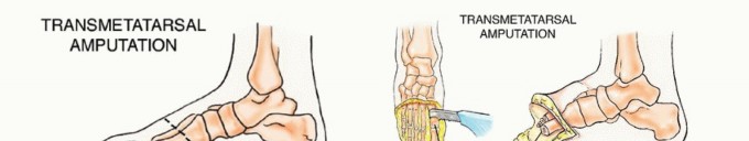 Illustration 22 for Treating Tumors of the Foot: Optimizing Amputation & Resection