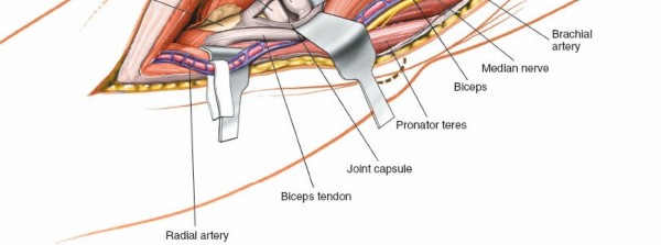 Illustration 85 for Mastering Elbow Approaches: Applied Surgical Anatomy for Precision