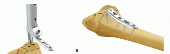 Illustration 30 for Fragment-Specific Fixation: Restore Carpal Facet Horizon