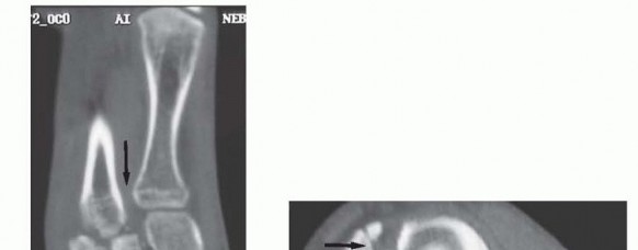 Illustration 8 for Fixation of Lisfranc Injuries: Essential Open Reduction Guide
