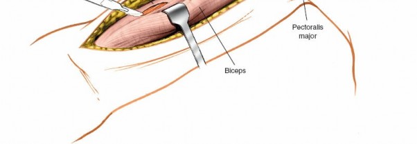 Illustration 11 for Mastering the Approach to the Distal Humerus: Safety & Skills