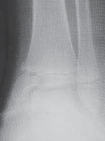 Illustration 28 for Pediatric Ankle Fractures: Management to Prevent Long-Term Issues