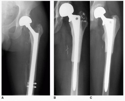 Illustration 28 for Allograft Prosthetic Composite: Mastering Proximal Femur Reconstruction