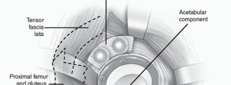 Illustration 12 for Recreate Hip Biomechanics: Modular Stems for Modular Solutions