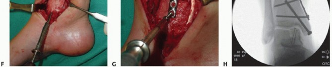 Illustration 21 for Unlock Healing: Medial Malleolar Osteotomy for Talus OLT Allografts