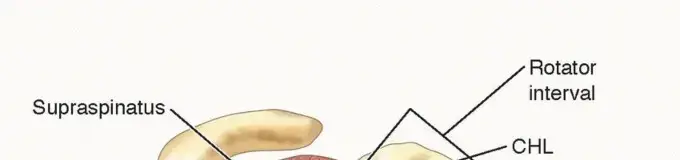 صورة توضيحية لـ خشونة مفصل الكتف: دليلك الشامل لعلاج تنظير الكتف وتصحيح التجويف الحقاني في اليمن والخليج العربي