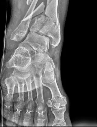 صورة توضيحية لـ كسر البيلون المعقد (AO/OTA C3): دليل شامل للمرضى من الأستاذ الدكتور محمد هطيف