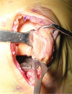 Illustration 24 for Cemented TKA Figure: Your Visual Guide to Surgical Success