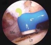 Illustration 27 for Arthroscopic Subscapularis Repair: The lo iky brady Method for Stability