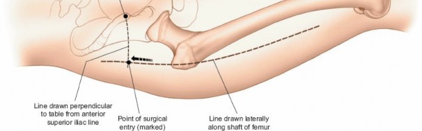 Illustration 71 for Optimal Femoral Approaches: Mastering the Lateral Intermuscular Septum
