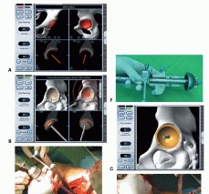 Illustration 24 for Hip Resurfacing: The Bone-Sparing Solution around the Femoral Head
