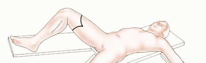 Illustration 13 for Mastering Above-Knee Amputation: Essential Surgical Insights