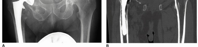 Illustration 13 for Mastering Revision THA: Strategies for Adverse Local Tissue Challenges