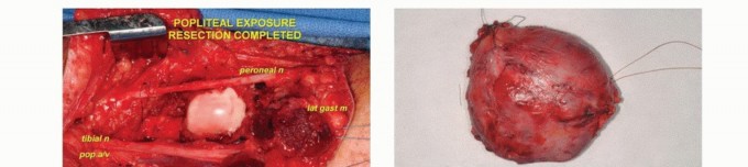 Illustration 18 for Complex Popliteal Resections: Protecting the Greater Saphenous Vein
