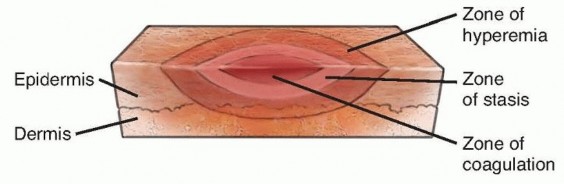 Surgical Treatment of Thermal Injuries of the Upper Extremity