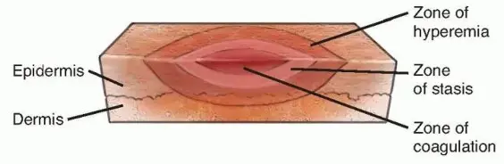 جراحات حروق الأطراف العلوية: دليل شامل للمرضى في اليمن والخليج مع الأستاذ الدكتور محمد هطيف