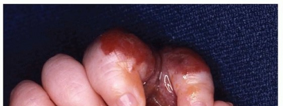 Surgical Treatment of Vascular Tumors of the Hand