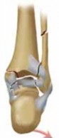 Illustration 6 for Optimal Fixation of the Ankle: Open Reduction & Internal Fixation
