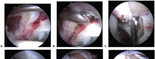 Illustration 116 for Mastering the Scope for Femoroacetabular Impingement