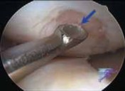 Illustration 13 for Microfracture Chondroplasty: How Tiny Holes Are Made to Fix Cartilage