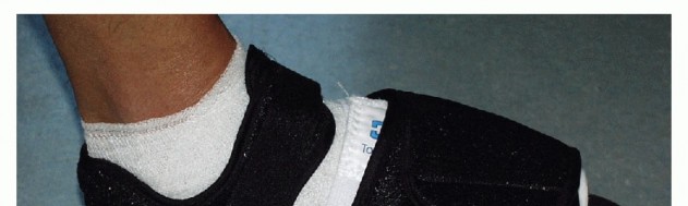 Illustration 23 for Mastering Extensive Plantar Release for Hallux Rigidus