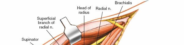 Illustration 64 for Mastering Elbow Approaches: Applied Surgical Anatomy for Precision