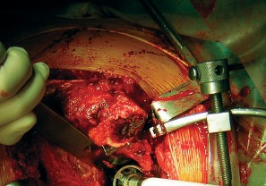 Illustration 48 for Cemented Component Longevity: The Critical Margin of the Acetabulum