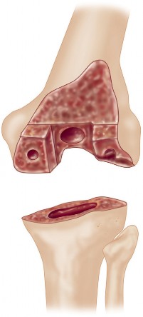 Illustration 2 for Structural Allografting Figure Guide: Solutions for Bone Deficiency