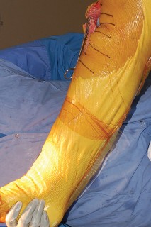 Illustration 48 for Mastering Gap Balancing in Revision TKA: Avoid Common Pitfalls